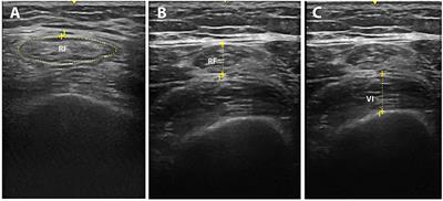 Neuromuscular Electrical Stimulation in Patients With Severe COVID-19 Associated With Sepsis and Septic Shock